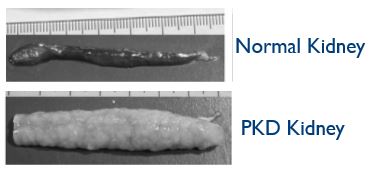 A comparison of a normal kidney and one infected with PKD